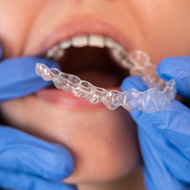 Close-up of an orthodontic specialist adjusting and placing invisible aligners on a caucasian woman. Concept of invisible orthodontic technique.